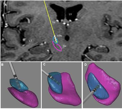 Anatomical Correlates of Uncontrollable <mark class="highlighted">Laughter</mark> With Unilateral Subthalamic Deep Brain Stimulation in Parkinson’s Disease